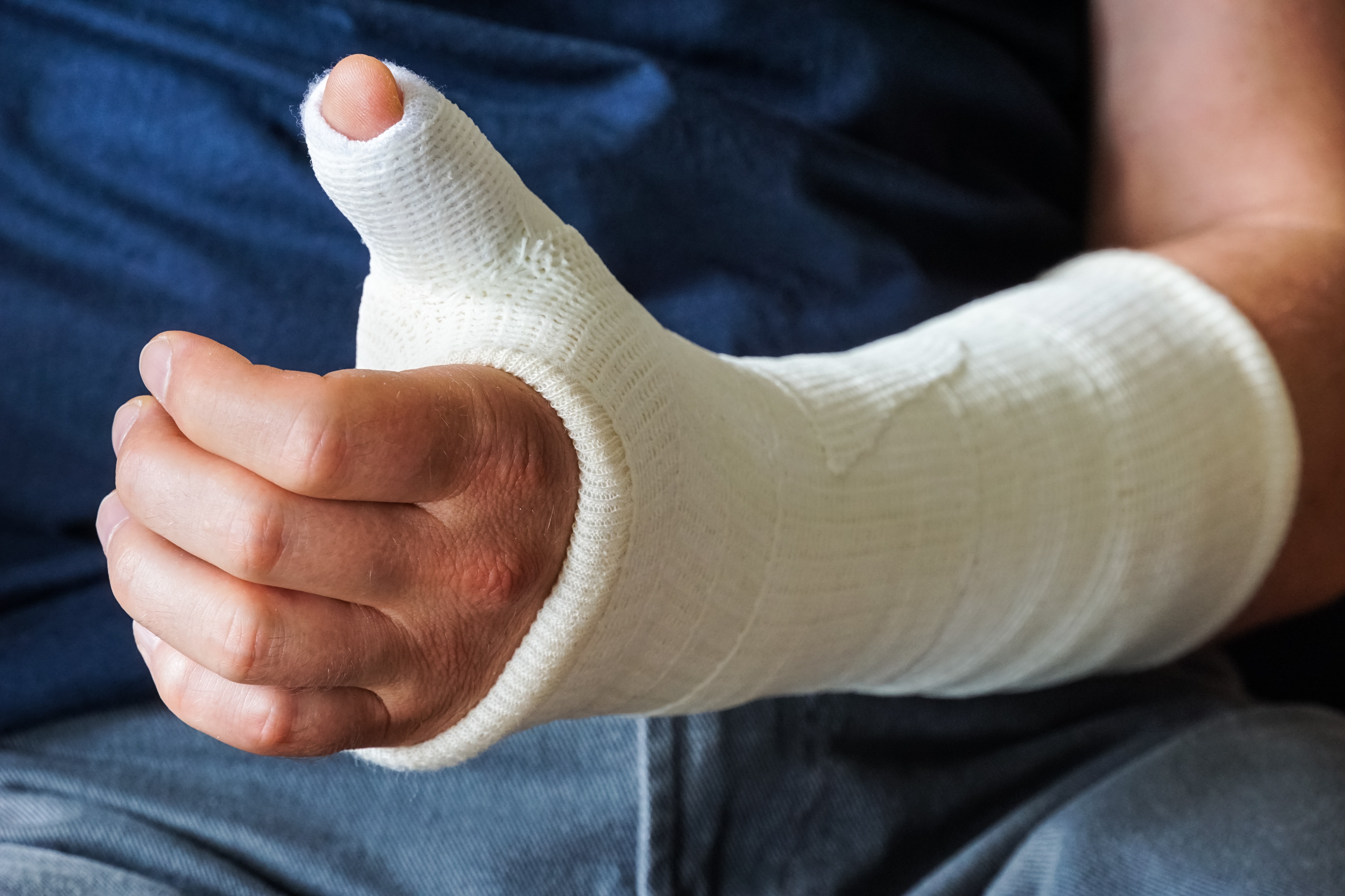 Plaster Cast